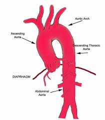 Virtualmedstudent Com Aortic Dissection Aortic Dissection Abdominal Aorta Anatomy And Physiology