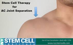 An Acromioclavicular Joint Separation Or Ac Separation Is A Very Frequent Injury Among Physically Active P Stem Cell Therapy Stem Cells Regenerative Medicine