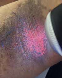 Image result for Erythrasma