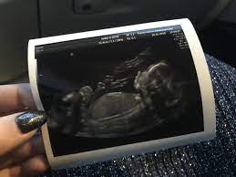 Ved undersøkelsen sjekker jordmoren at barnet vokser normalt, at det. Pilotfrue Ordinaer Ultralyd Og Termindato