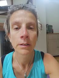 Don't let treatment be a postcode lottery' urge North West Long Covid  patients