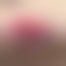 Image result for Skin Tear