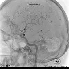 Anevrismele cerebrale pot erupe şi cauza sângerări în creier, ceea ce duce la hemoragie subarahnoidiană. Patologie Endovasculara Clinica De Neurochirurgie Timisoara
