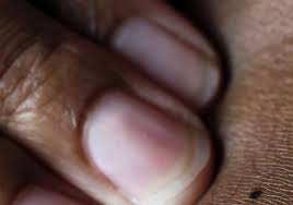 If breast cancer is diagnosed at an early enough stage, it's treatable. Skin Cancer Is Color Blind The Blade