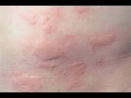 Lifestyle changes to prevent and cope with itchy skin. Skin Allergy Symptoms Diagnosis Treatment Home Remedies For Skin Allergy Health First Youtube