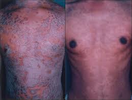 Comparative Evaluation Of Nbuvb Phototherapy And Puva Photochemotherapy In Chronic Plaque Psoriasis Dayal S Mayanka Jain V K Indian J Dermatol Venereol Leprol