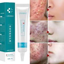 20g Cleansing Acne Cream For Acne Skin Whitening Cream Skin Care Spot Acne Melanin Face Facial Creams Treatment Nourish Life New Bb Cc Creams Aliexpress