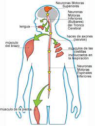 Sí, la la esclerosis lateral amiotrófica causa complicaciones si no es tratada. Encuentra Aqui Informacion De Esclerosis Lateral Amiotrofica Para Tu Escuela Entra Ya Rincon Del Vago