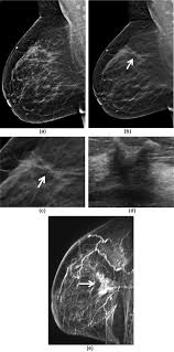 This means that the test finds a mass or other change that seems to show cancer but it is not cancer. Assessment Of Disease Extent On Contrast Enhanced Mri In Breast Cancer Detected At Digital Breast Tomosynthesis Versus Digital Mammography Alone Clinical Radiology