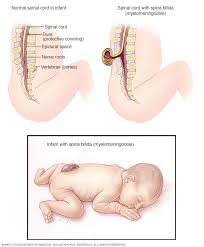 Seems the right side is bulging there right. Spina Bifida Symptoms And Causes Mayo Clinic