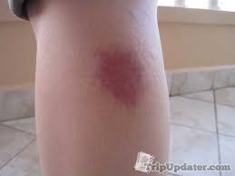 Skeeter syndrome, (or bite of the living dead) the mosquitoes have got to know by now that as soon as they bite you, the party is over. Pin On Skeeter Syndrome Pictures