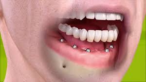 Maybe you would like to learn more about one of these? Teeth In A Day Orlando Fl Koyfman Dental