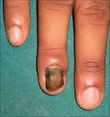 Image result for onychomycosis