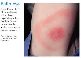 Image result for Lyme Carditis