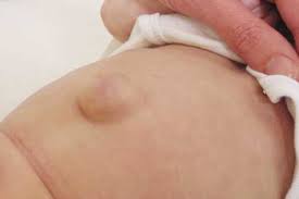 Envuelve Con Una Faja Las Hernias De Tu Bebe Elembarazo Net