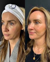 When you're ready for that next-level result and can commit to the journey…  DEKA CO₂ has officially entered the chat. Think our gentle CoolPeel CO₂,  but multiply the results fivefold. This isn't