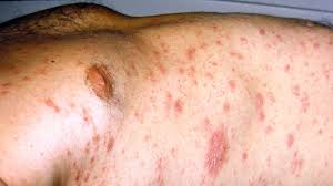Image result for Generalized Rash
