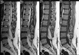 Image result for Spinal Dysraphism