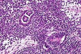 Image result for Nephroblastoma