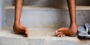 Information about when is world clubfoot day 2020, and countdown clock showing the number of days, hours, minutes & seconds until the beginning of the world clubfoot day. Holiday Calendar World Clubfoot Day June 3