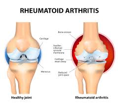 Image result for Rheumatoid Factor