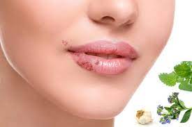 Mâncați așadar, acest tratament cu usturoi este atât de sănătos deoarece restricționează folosirea sării și adaugă grăsimi sănătoase preparatelor, precum. Cum Scapi De Herpes Cu Ajutorul Plantelor Medicinale