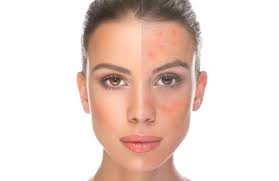 Résultat de recherche d'images pour "rosacea"