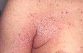 Image result for scabies symptoms