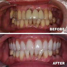 Looking for wisdom teeth removal near me? Private Dentist Liverpool Apollonia Dental Cosmetic Centre