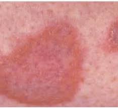 They might go away personally in time but it might as they are harmless and take much time. Recent Insights On Diabetic Dermopathy Fulltext