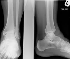 Image result for Ankle XRay