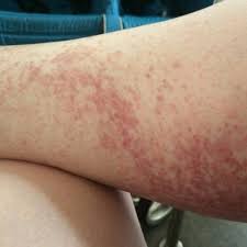Maybe you would like to learn more about one of these? The Disney Rash Description Prevention And Treatment Build A Better Mouse Trip