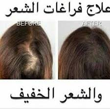 تجارب زيت الحشيش للثعلبة 0540428830 العلاج الأفضل لفروة الرأس موثوق Mawthook