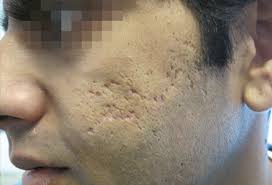 We find out how to get rid of acne scars through expert recommended treatments. Picture Of Skin Diseases And Problems Ice Pick Scars