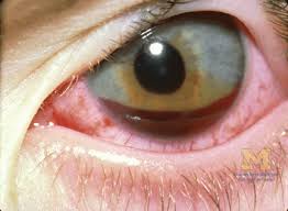 Image result for Hyphema