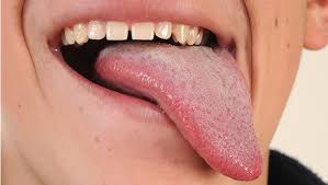 Oral Thrush Fungi Oral Candidiasis Tongue Infection Overgrowth Builds Up As Whitish Plaque Budding Yeasts And Hyphal Fungi Invade Burning Tongue Tongue Health
