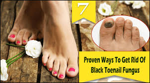 #209 how to tell a bruise under the toenail from toenail 7 proven ways to get rid of black toenail fungus. Facebook