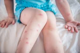 Bed Bug Bites That Look Like Mosquito Bites Pin On Bites And Stings