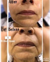 Maybe you would like to learn more about one of these? Dr Haya Ajami Treatment Marionette Lines Filler