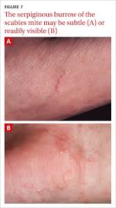 Image result for scabies human bites