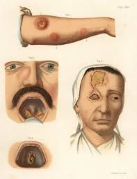 Image result for syphilis symptoms