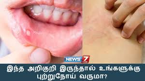 General signs of throat cancer may include the following trouble swallowing: à®‡à®¨ à®¤ à®…à®± à®• à®± à®‡à®° à®¨ à®¤ à®² à®‰à®™ à®•à®³ à®• à®• à®ª à®± à®± à®¨ à®¯ à®µà®° à®® à®Ÿ à®• à®Ÿà®° à®š à®µà®° à®® à®•à®© à®šà®® à®© News7 Tamil Youtube