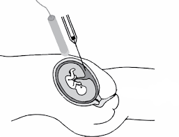 Image result for Chorionic Villus Sampling