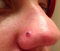 You could also form a hematoma, a swollen bruise that can become infected or disfigure your face. Parity How Can I Tell If My Nose Piercing Is Infected Up To 61 Off