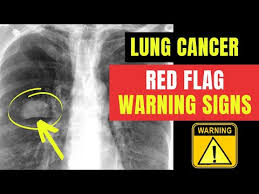 Image result for lung cancer xray