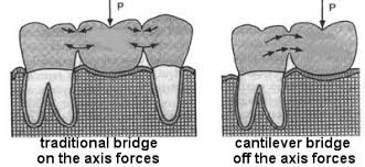 We did not find results for: What Is A Cantilever Dental Bridge