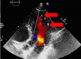 Image result for Left Ventricular Noncompaction