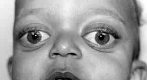 Potocki Lupski Syndrome Medlineplus Genetics
