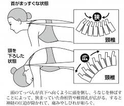 首が痛む 頸椎症 は治せる 医師考案 うなじ伸ばし で神経の圧迫を緩めよう カラダネ 肩 痛み 椎間板ヘルニア 首の痛み