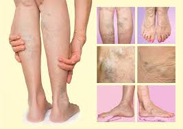9 Hidden Health Risks Of Untreated Varicose Veins Njvvc